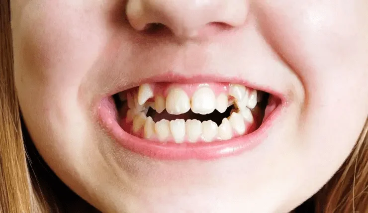 Кривые молочные зубы: когда начинать лечение? — стоматология Family Smile, Сочи