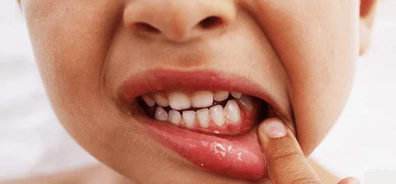 Гингивит у детей: причины, симптомы и методы лечения — стоматология Family Smile, Сочи